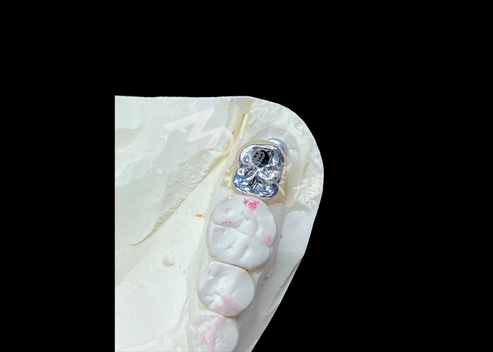 Dental Implant Crown With Titanium Abutment And Porcelain-Fused-to-Metal PFM Crown