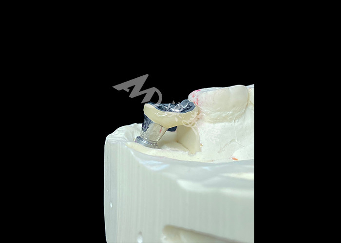 Dental Implant Crown With Titanium Abutment And Porcelain-Fused-to-Metal PFM Crown