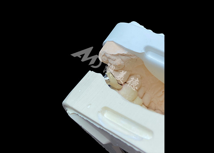 Dental Implant Crown With Titanium Abutment And Porcelain-Fused-to-Metal PFM Crown