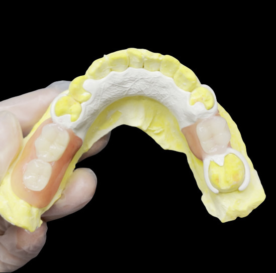 Aesthetic Custom made Removable Partial Denture HPP Framework for Natural Partial Tooth Replacement