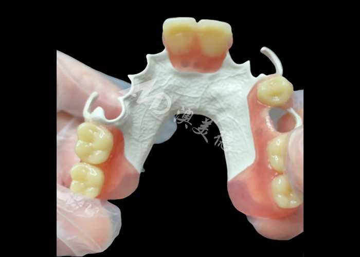 Aesthetic Custom made Removable Partial Denture HPP Framework for Natural Partial Tooth Replacement
