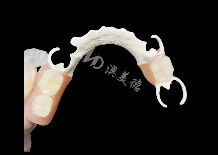 Custom Cast Partial Denture with HPP framework for Enhanced Chewing and Speech