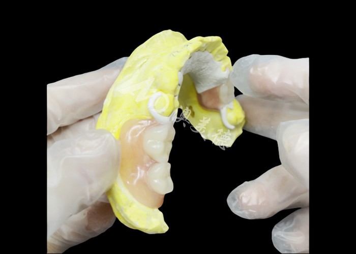 Custom Cast Partial Denture with HPP framework for Enhanced Chewing and Speech