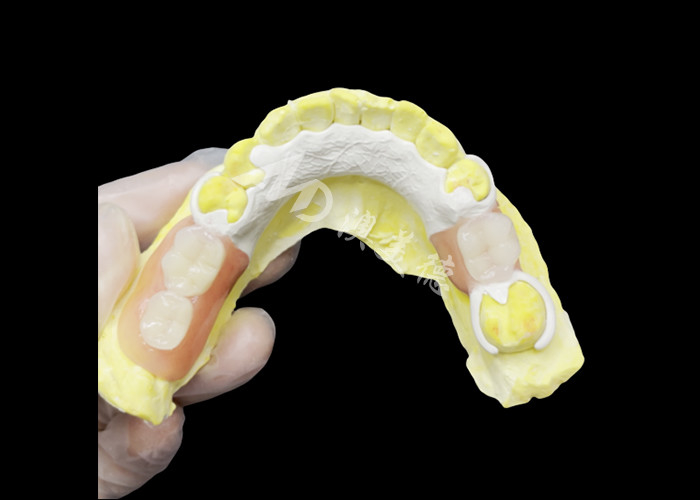 Custom Cast Partial Denture with HPP framework for Enhanced Chewing and Speech