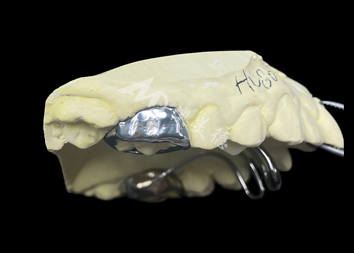 Tongue Cribs Orthodontic Appliance Used To Address Tongue Thrust Issues And Aid In Proper Dental Alignment