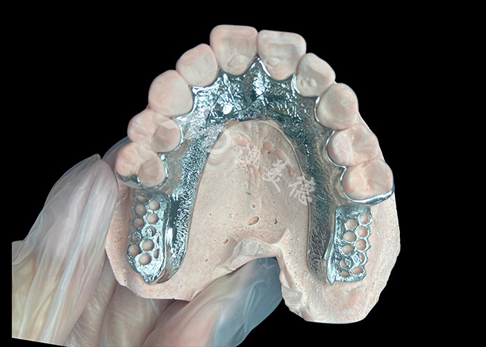 Custom Cast Partial Denture Dental Prosthetic Framework Without Teeth Set Up for Stability And Function