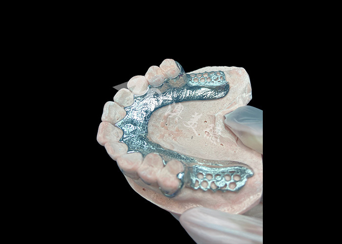 Custom Cast Partial Denture Dental Prosthetic Framework Without Teeth Set Up for Stability And Function