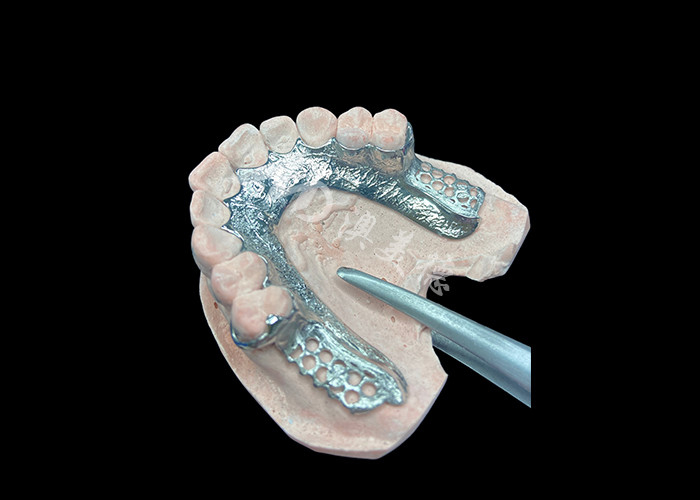 Custom Cast Partial Denture Dental Prosthetic Framework Without Teeth Set Up for Stability And Function