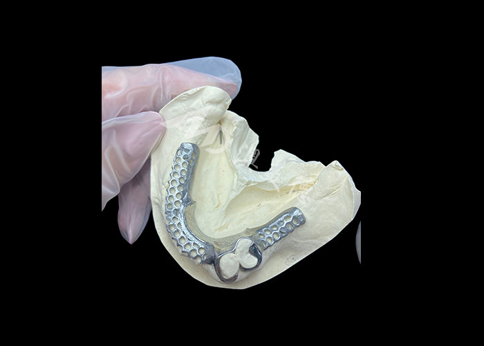 Easy Fit Custom Cast Partial Denture Stable and Natural-looking Framework for Fast Results