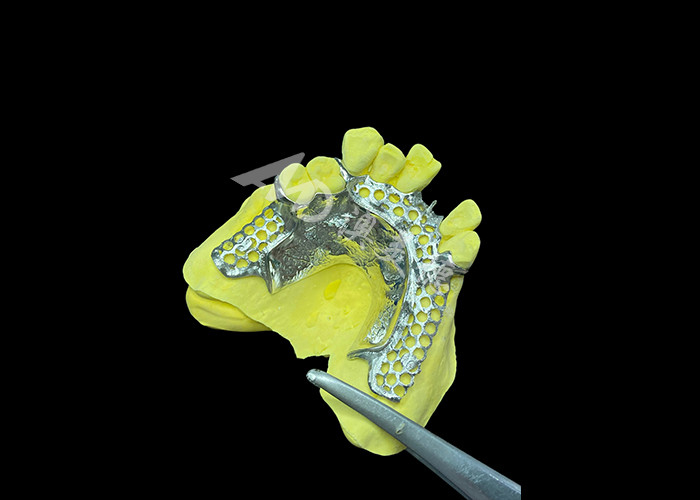Custom Cast Partial Denture Natural Looking Solution For Enhanced Comfort And Speech