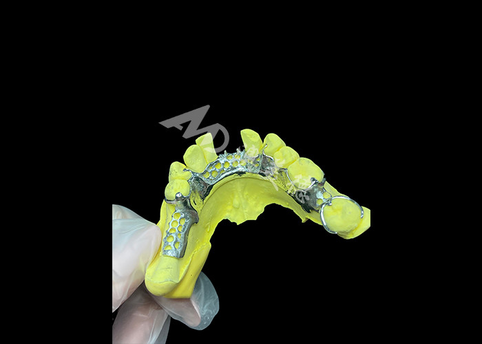Custom Cast Partial Denture Natural Looking Solution For Enhanced Comfort And Speech