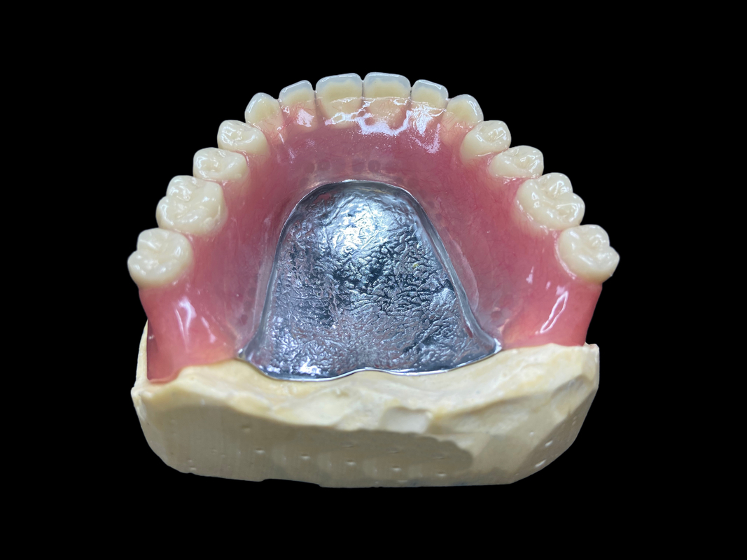 Easy-to-Clean Custom Cast Partial Dentures Ideal for Restoring Chewing Ability and Smiles