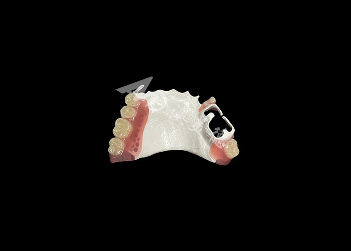 High Quality Comfortable Partial Denture With HPP Framework Restores Chewing And Speaking Ability