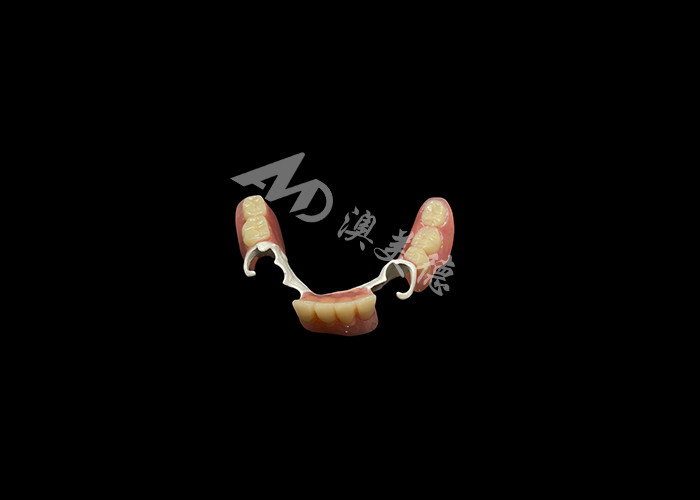Custom Made Durable Cast Partial Dentures With Hpp Framework For Restoring Your Smile