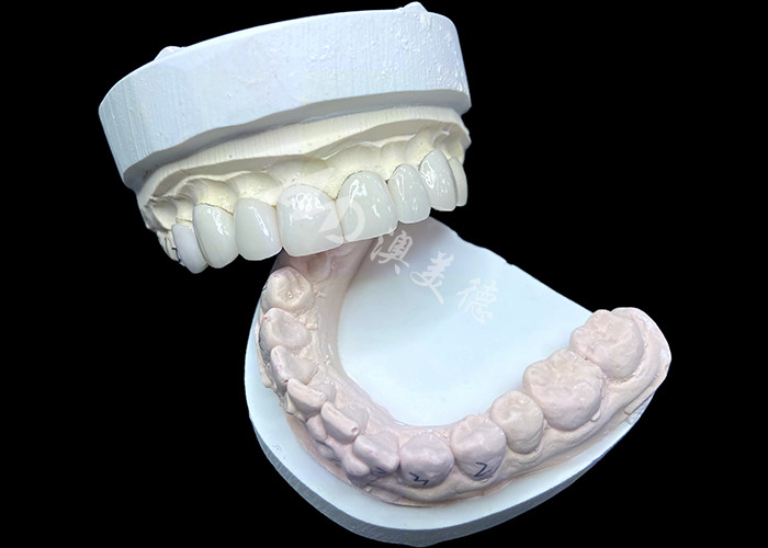 IPS e.max Veneers in Shade BL2 Achieve Stunning Natural Aesthetics with 8 Perfectly Crafted Units