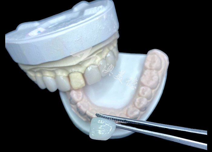 IPS e.max Veneers in Shade BL2 Achieve Stunning Natural Aesthetics with 8 Perfectly Crafted Units