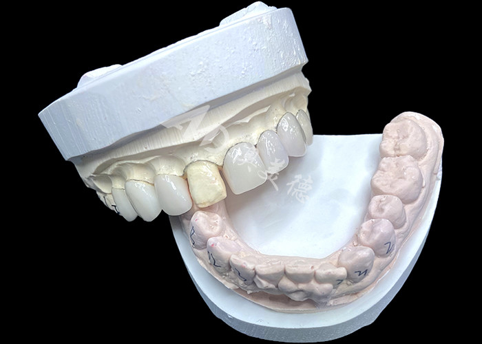 IPS e.max Veneers in Shade BL2 Achieve Stunning Natural Aesthetics with 8 Perfectly Crafted Units