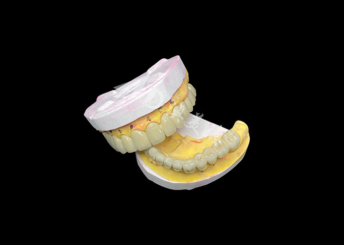 Customized Porcelain Fused To Metal Dental Crown Bridge For Natural Smile Enhancement