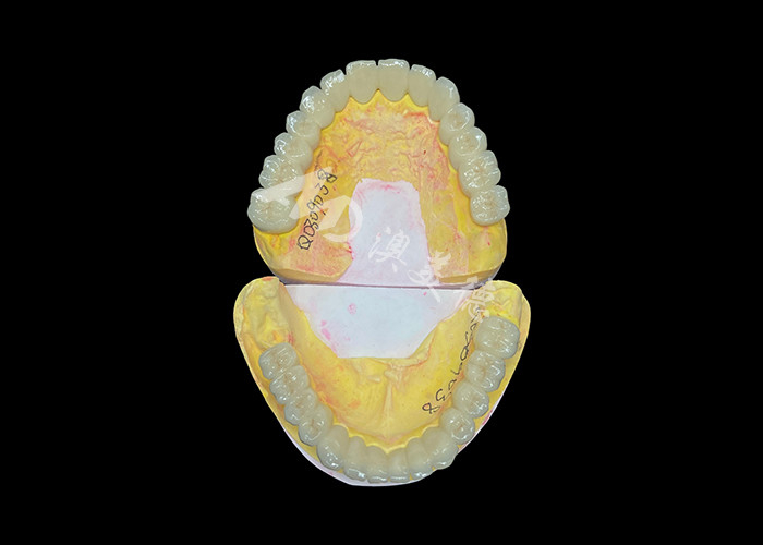 Customized Porcelain Fused To Metal Dental Crown Bridge For Natural Smile Enhancement