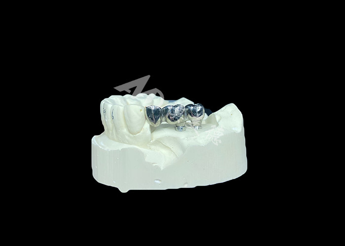Long-lasting Full Cast Titanium Crown Dental Implant Molar For Missing Teeth Replacement