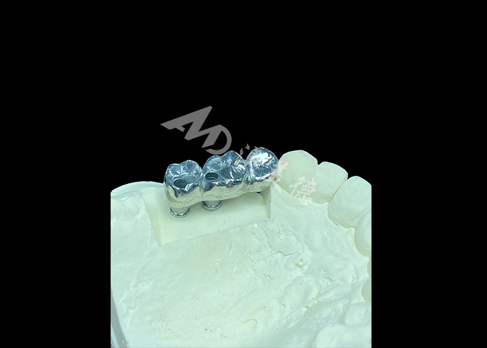 Long-lasting Full Cast Titanium Crown Dental Implant Molar For Missing Teeth Replacement
