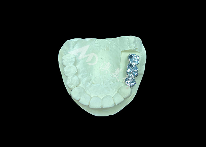 Long-lasting Full Cast Titanium Crown Dental Implant Molar For Missing Teeth Replacement