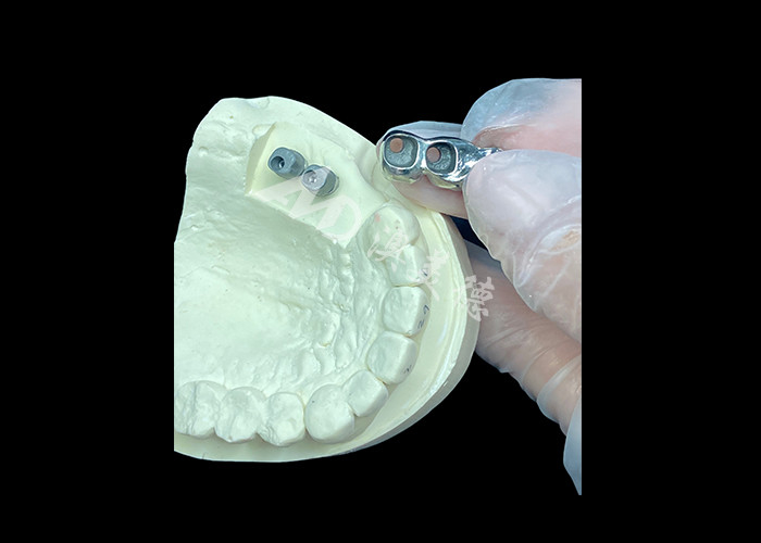 Long-lasting Full Cast Titanium Crown Dental Implant Molar For Missing Teeth Replacement