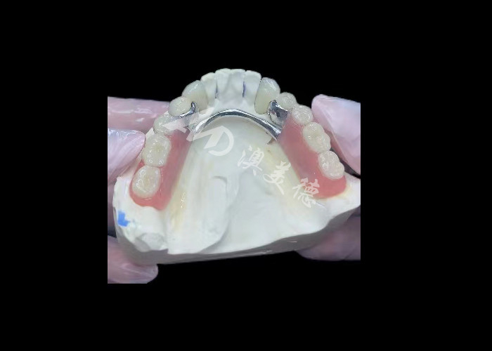 Durable Porcelain Fused To Metal Dental Crown PFM Crown For Restoration