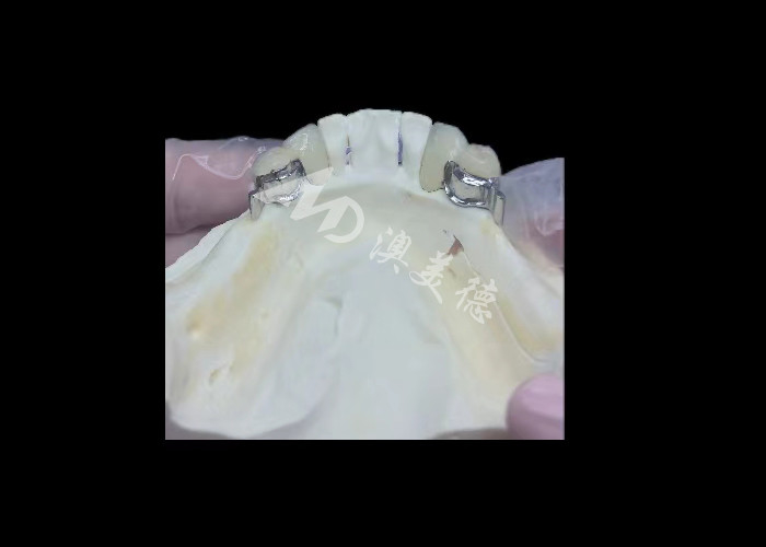 Durable Porcelain Fused To Metal Dental Crown PFM Crown For Restoration