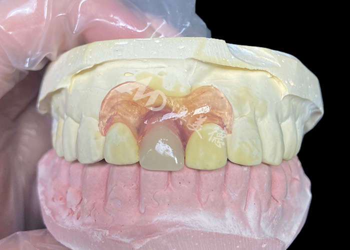 Nesbit flexible partial denture for incisors offering a seamless removable tooth replacement solution