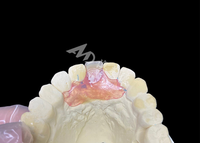 Nesbit flexible partial denture for incisors offering a seamless removable tooth replacement solution