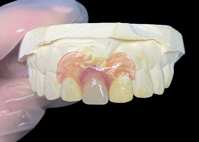 Nesbit flexible partial denture for incisors offering a seamless removable tooth replacement solution