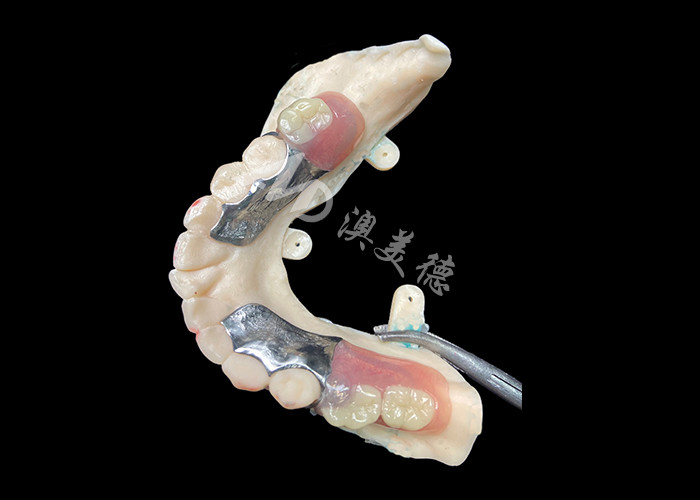 Customized Cast Partial Dentures Precision Metal Framework For Optimal Fit And Functionality