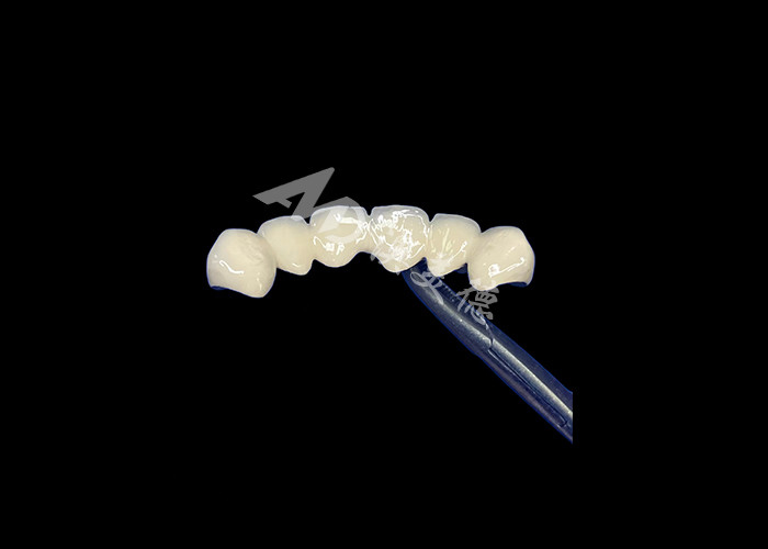 Biocompatible Porcelain Fused To Metal Crown High Durability For Enhanced Restoration
