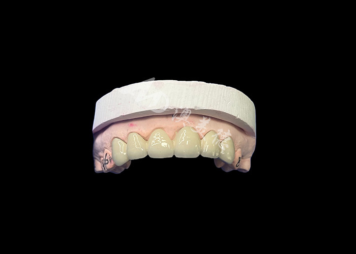 Biocompatible Porcelain Fused To Metal Crown High Durability For Enhanced Restoration