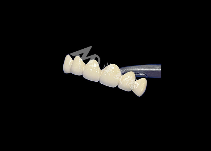 Biocompatible Porcelain Fused To Metal Crown High Durability For Enhanced Restoration
