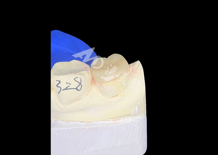 IPS E.max Ceramic Inlays Onlays Seamless Blend Natural-looking And Durable With Your Teeth