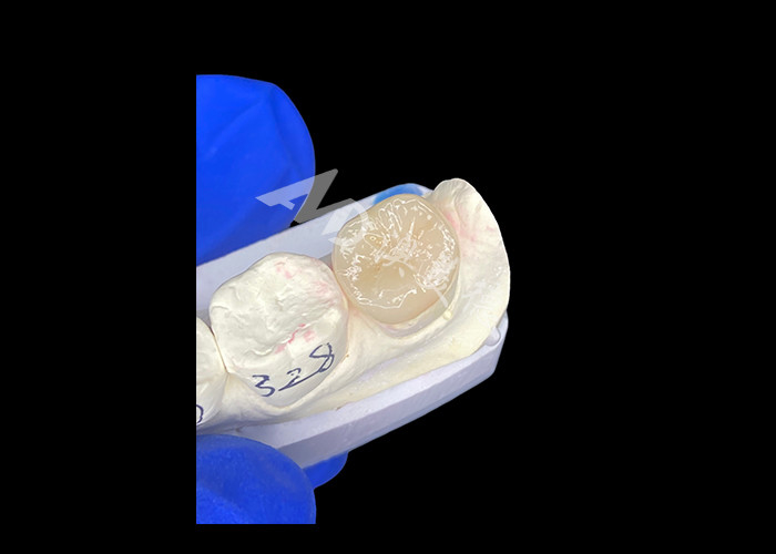 IPS E.max Ceramic Inlays Onlays Seamless Blend Natural-looking And Durable With Your Teeth