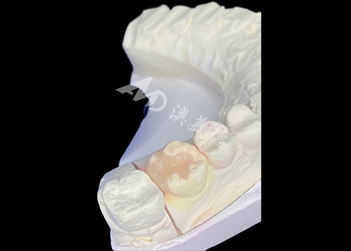 IPS e.max Ceramic Inlays and Onlays for Molar Restoration with Durable Aesthetic and Natural Looking Results