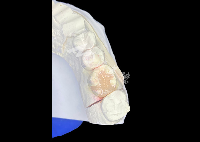 IPS e.max Ceramic Inlays and Onlays for Molar Restoration with Durable Aesthetic and Natural Looking Results
