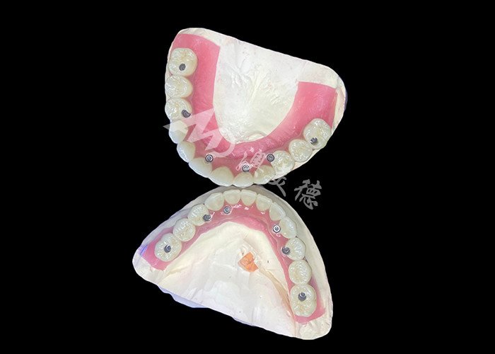 Dental All-on-6 Dental Implant Supported Dentures With Stability And Comfort