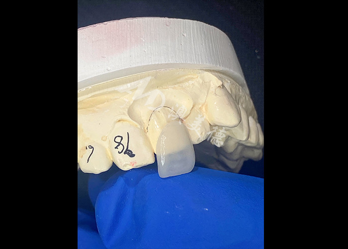 IPS e.max Veneers for incisor in shade A1 Natural Aesthetics for Flawless Smiles