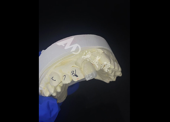 IPS e.max Veneers for incisor in shade A1 Natural Aesthetics for Flawless Smiles