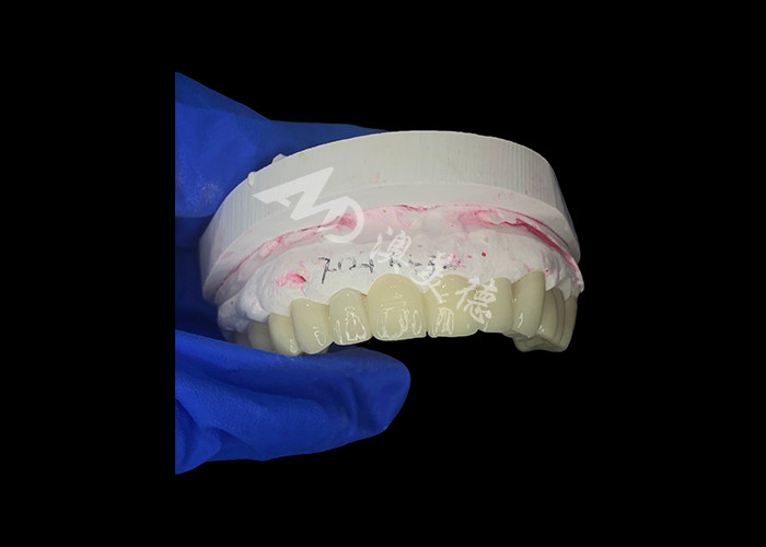 High Translucency Zirconia Dental Bridge Strong and Natural Looking for Seamless Smile Restoration