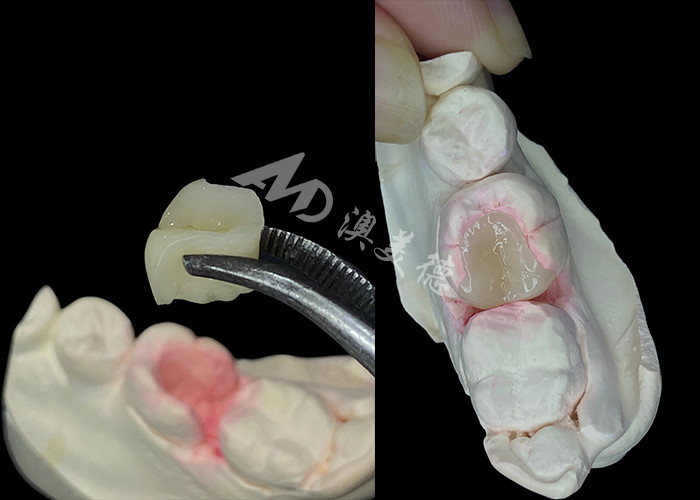 IPS e.max Ceramic Inlays and Onlays for Natural Looking Dental Restoration