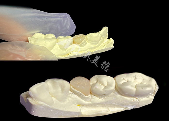 IPS e.max Ceramic Inlays and Onlays for Natural Looking Dental Restoration