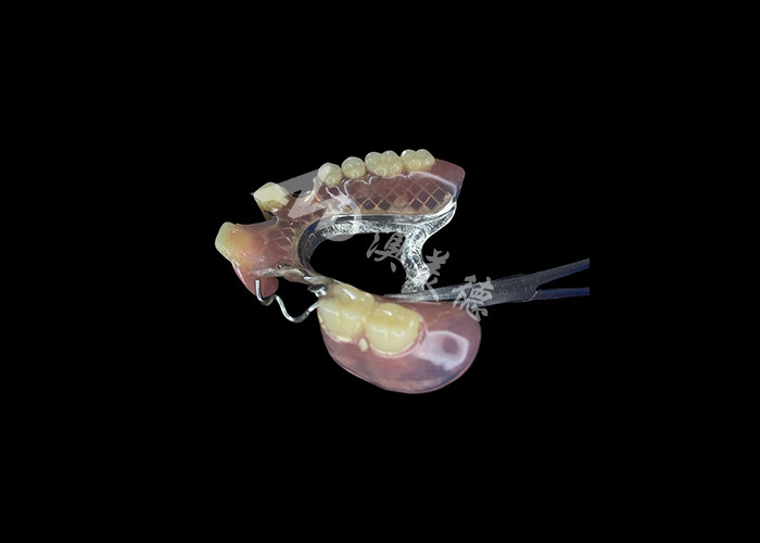 Customizable Fit Cast Partial Dentures for Precision Durability and Comfort in Partial Tooth Replacement