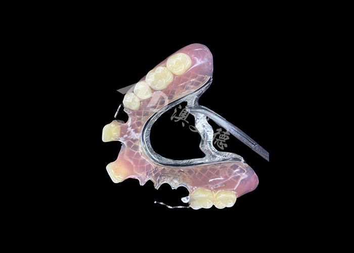 Customizable Fit Cast Partial Dentures for Precision Durability and Comfort in Partial Tooth Replacement
