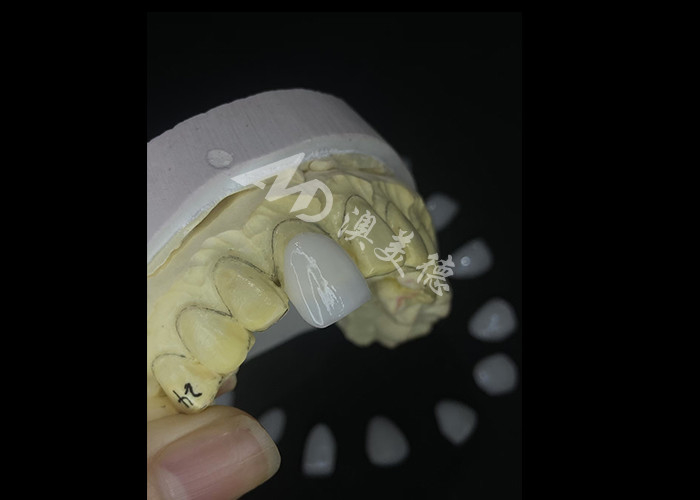 Precision Crafted IPS e.max Veneers for Unrivaled Smile Transformations Delivering Exceptional Durability Aesthetics