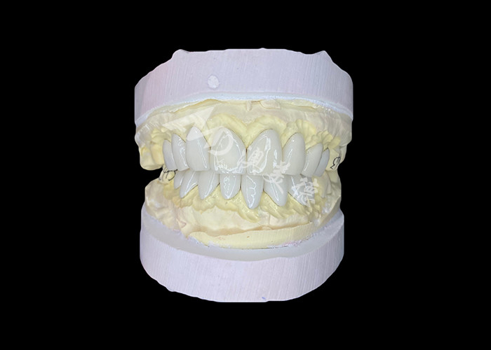 Precision Crafted IPS e.max Veneers for Unrivaled Smile Transformations Delivering Exceptional Durability Aesthetics